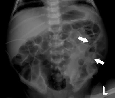 A case report of necrotizing enterocolitis in a moderately preterm neonate with LCHADD—A call to focus on the basics while utilizing advanced new therapies